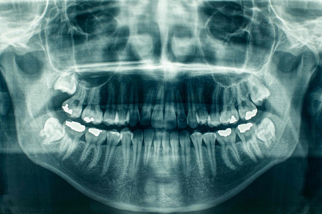 Picture of: Dental X-Rays: Panoramic vs. Traditional – J.D