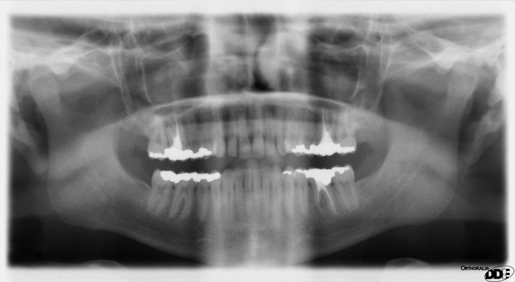Picture of: Panoramic radiograph – Wikipedia